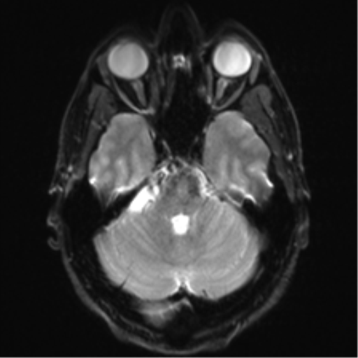 Arachnoid cyst - cerebellopontine angle (Radiopaedia 59689-67083 Axial DWI 11).png