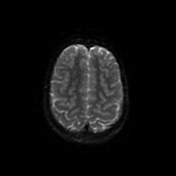 Arachnoid cyst - middle cranial fossa (Radiopaedia 67671-77088 Axial DWI 49).jpg