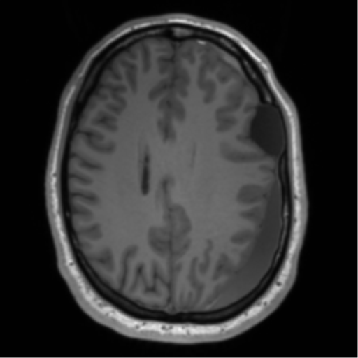 File:Arachnoid cyst with subdural hematoma (Radiopaedia 85892-101743 Axial T1 58).png