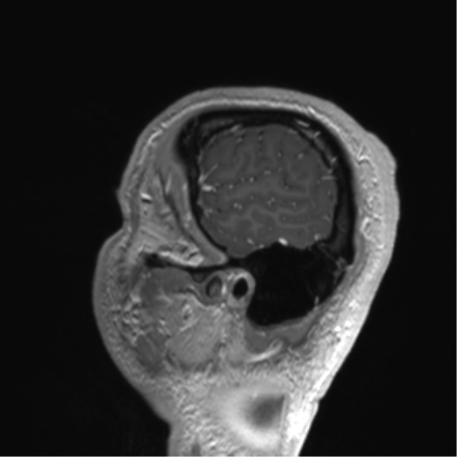 Arachnoid cyst with subdural hematoma (Radiopaedia 85892-101743 Sagittal T1 C+ 82).png
