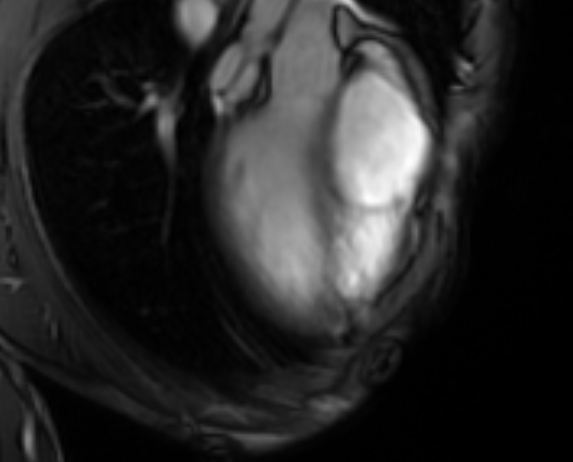 File:Arrhythmogenic right ventricular cardiomyopathy (Radiopaedia 69564-79464 4ch cine 19).jpg