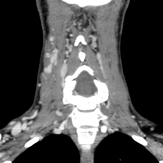 Arteriovenous malformation of the neck (Radiopaedia 53935-60062 D 24).jpg