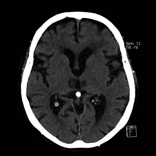 File:Artery of Percheron infarction (Radiopaedia 26307-26439 Axial non-contrast 16).jpg