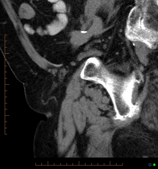 File:Artificial urethral sphincter (Radiopaedia 46937-51464 Sagittal C+ delayed 10).jpg