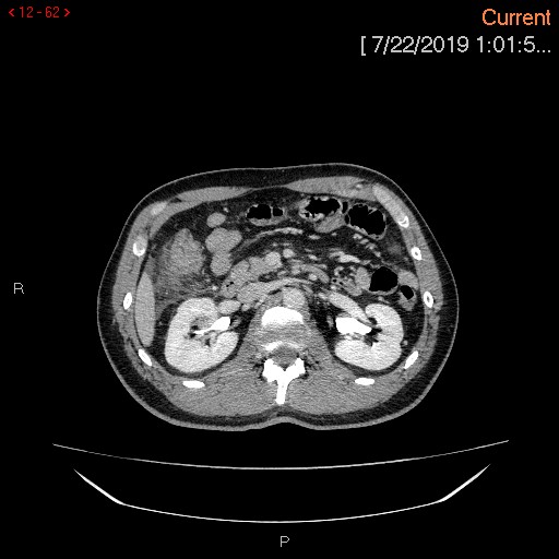 Ascending colonic diverticulum mimicking acute appendicitis (Radiopaedia 69943-80198 A 62).jpg