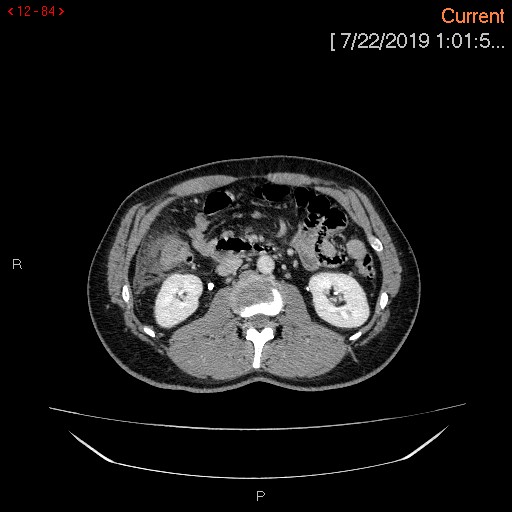 File:Ascending colonic diverticulum mimicking acute appendicitis (Radiopaedia 69943-80198 A 84).jpg