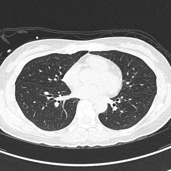 File:Aspergilloma (Radiopaedia 26223-26347 Axial lung window 45).jpg