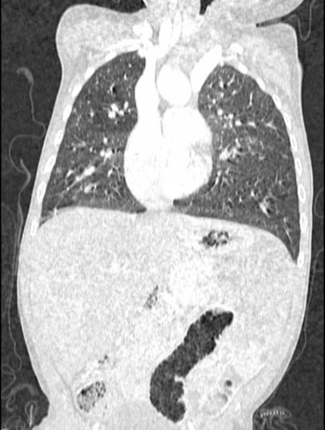 Asplenia syndrome (Radiopaedia 73083-83792 Coronal lung window 63).jpg