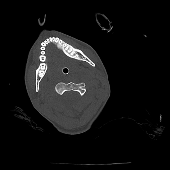 Atlanto-occipital dissociation (Traynelis type 1), C2 teardrop fracture, C6-7 facet joint dislocation (Radiopaedia 87655-104061 Axial bone window 29).jpg