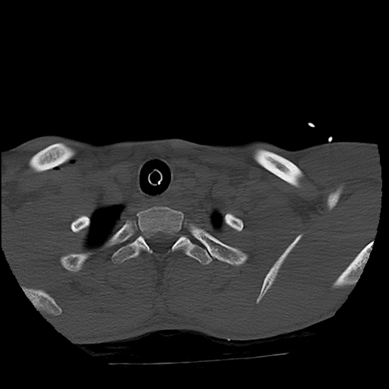 Atlanto-occipital dissociation (Traynelis type 1), C2 teardrop fracture, C6-7 facet joint dislocation (Radiopaedia 87655-104061 Axial bone window 90).jpg