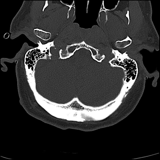 File:Atlas (type 3b subtype 1) and axis (Anderson and D'Alonzo type 3, Roy-Camille type 2) fractures (Radiopaedia 88043-104607 Axial bone window 3).jpg