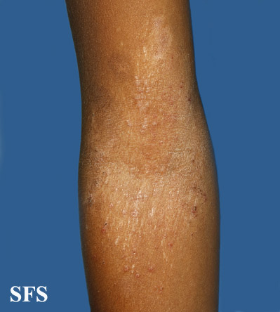 Atopic Dermatitis (Dermatology Atlas 33).jpg