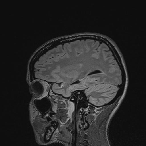 Atretic encephalocoele with inferior vermis hypoplasia (Radiopaedia 30443-31108 Sagittal FLAIR 111).jpg