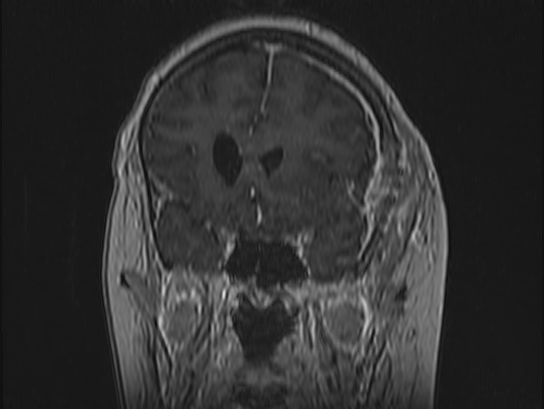 Atypical meningioma (Radiopaedia 62985-71406 Coronal T1 C+ 36).jpg