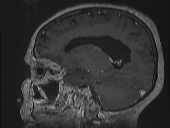 Atypical meningioma (Radiopaedia 62985-71406 Sagittal T1 C+ 30).jpg