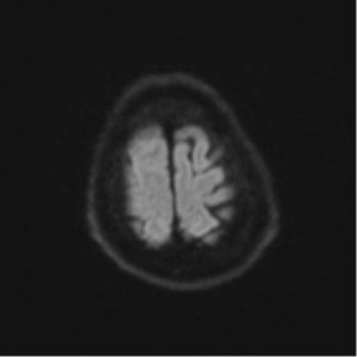 Atypical meningioma (WHO Grade II) (Radiopaedia 54742-60979 Axial DWI 53).png