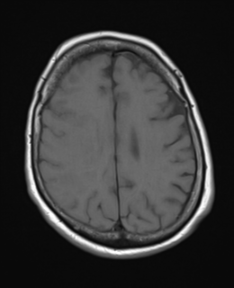 File:Atypical meningioma (WHO Grade II) (Radiopaedia 54742-60979 Axial T1 19).png