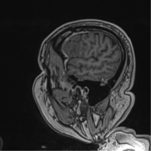 Atypical meningioma (WHO grade II) with brain invasion (Radiopaedia 57767-64729 Sagittal T1 C+ 55).png