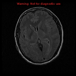 File:Atypical meningioma - grade II (Radiopaedia 13303-13305 Axial FLAIR 11).jpg