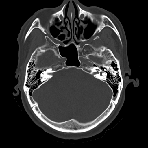 Atypical meningioma with skull invasion (Radiopaedia 34357-35649 Axial bone window 22).png