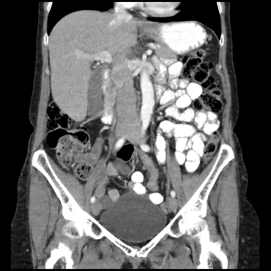 File:Atypical renal cyst (Radiopaedia 17536-17251 C 22).jpg