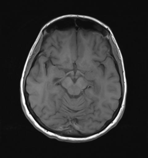 File:Autoimmune limbic encephalitis (Radiopaedia 30363-31005 Axial T1 14).jpg