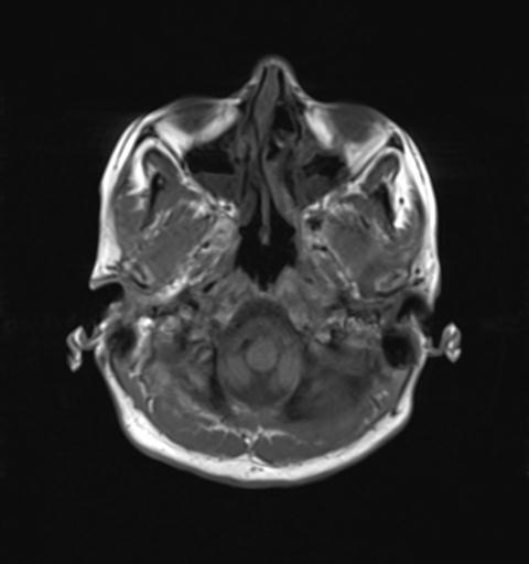 File:Autoimmune limbic encephalitis (Radiopaedia 30363-31005 Axial T1 5).jpg