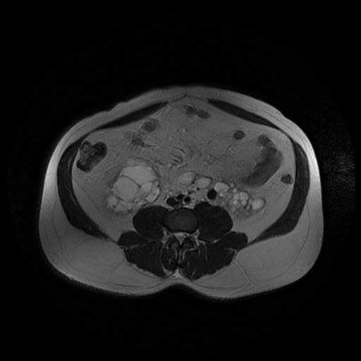 File:Autosomal dominant polycystic kidney disease (Radiopaedia 50259-55611 Axial T2 32).jpg