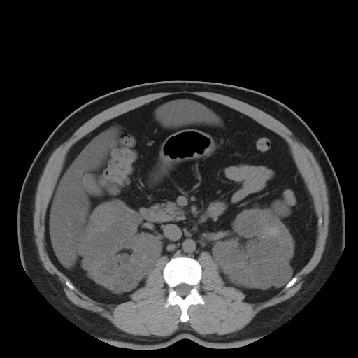 Autosomal dominant polycystic kidney disease (Radiopaedia 50259-55612 Axial non-contrast 36).jpg