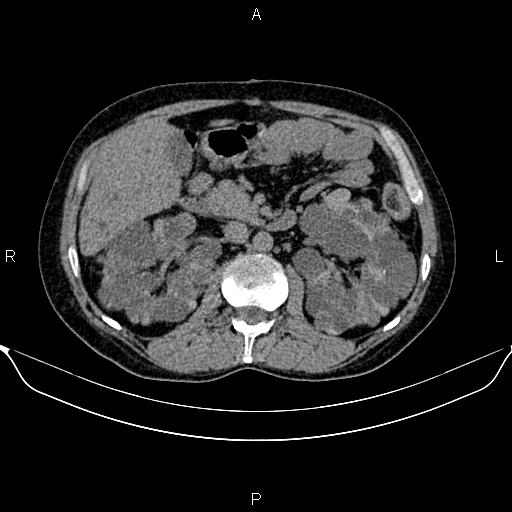 Autosomal dominant polycystic kidney disease (Radiopaedia 87830-104287 Axial non-contrast 23).jpg