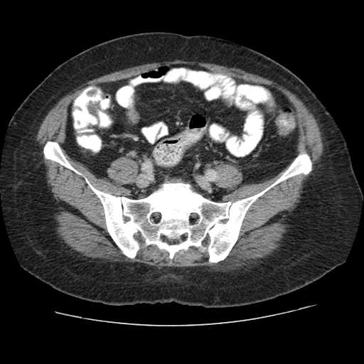 Autosomal dominant polycystic kidney disease with hepatic involvement (Radiopaedia 32693-33662 B 59).jpg