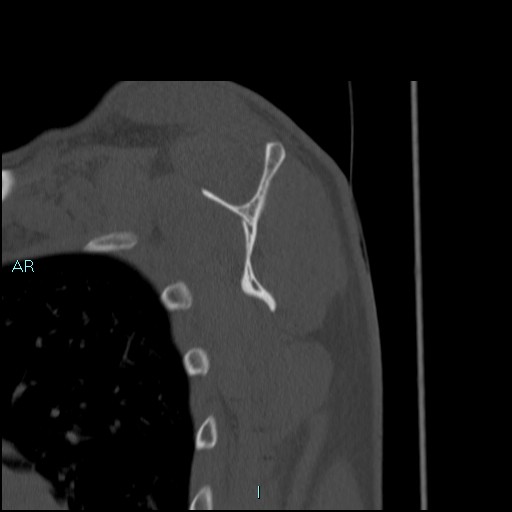Avascular necrosis after fracture dislocations of the proximal humerus (Radiopaedia 88078-104653 Sagittal bone window 51).jpg