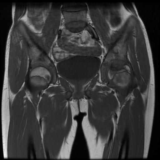 File:Avascular necrosis of the hip (Radiopaedia 29563-30067 Coronal T1 6).jpg