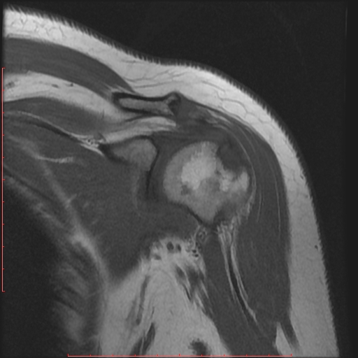 File:Avulsion fracture - greater tuberosity of humerus (Radiopaedia 25457-25703 Coronal T1 5).jpg