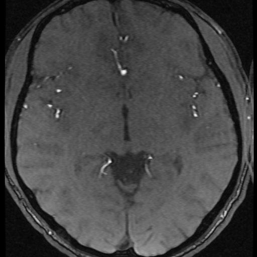 Azygos anterior cerebral artery (Radiopaedia 17059-16756 Axial MRA 21).jpg