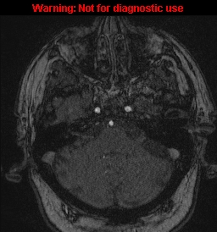 Azygos anterior cerebral artery (Radiopaedia 59325-66677 Axial MRA 32).jpg