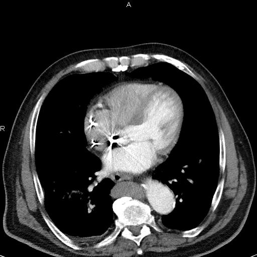 File:Azygos continuation of the inferior vena cava (Radiopaedia 18537-18404 C+ arterial phase 37).jpg