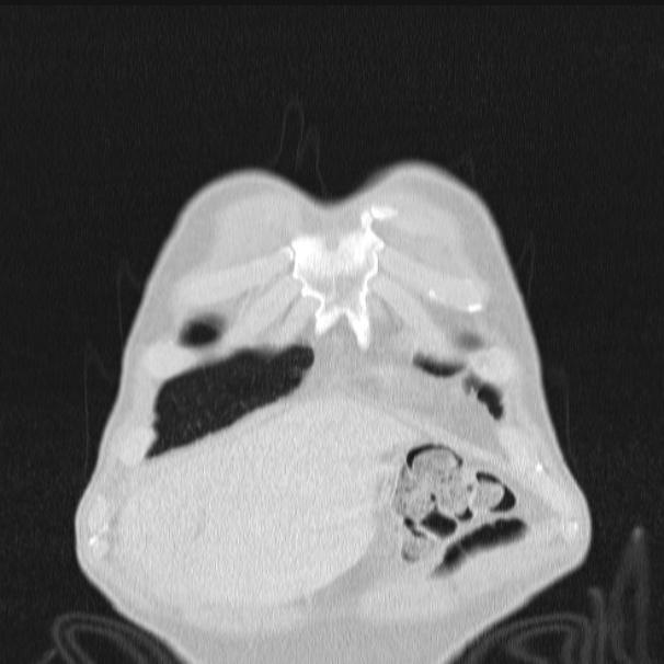 Azygos lobe (Radiopaedia 38259-40275 Coronal lung window 9).jpg