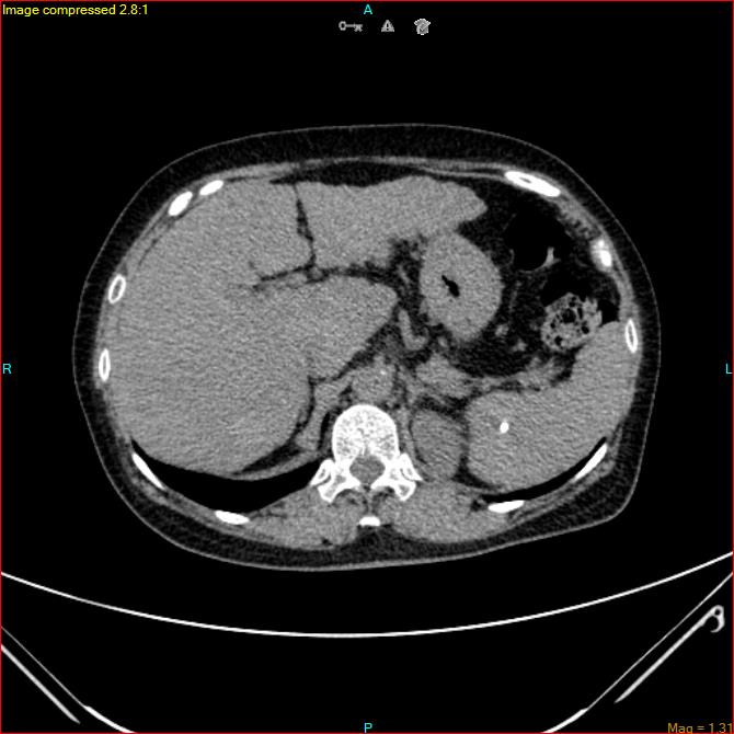 Azygos vein aneurysm (Radiopaedia 77824-90130 A 53).jpg