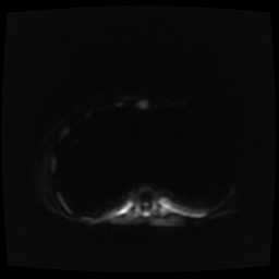 B cell lymphoma (Radiopaedia 56281-62954 Axial DWI 2).jpg
