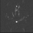 Balo concentric sclerosis (Radiopaedia 50458-55940 Axial DWI 68).jpg