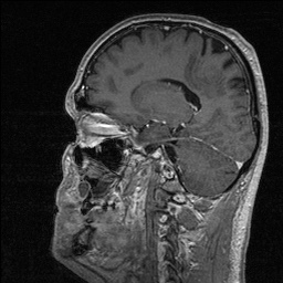 File:Balo concentric sclerosis (Radiopaedia 50458-55940 Sagittal T1 C+ 62).jpg
