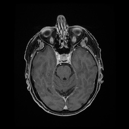 Balo concentric sclerosis (Radiopaedia 53875-59982 Axial LAVA C+ 92).jpg