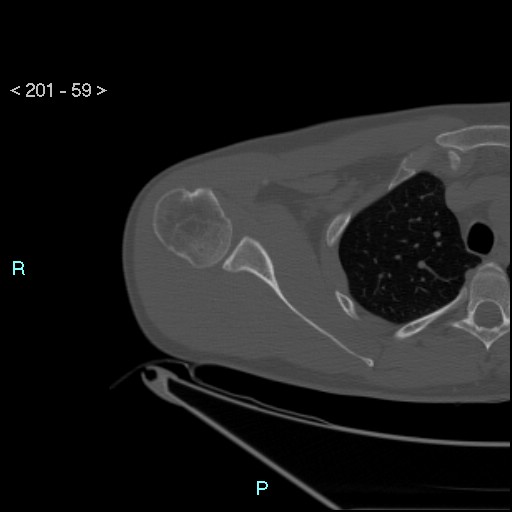 File:Bankart lesion with glenoid bone defect - assessment TC with PICO method (Radiopaedia 42855-93901 Axial bone window 58).jpg