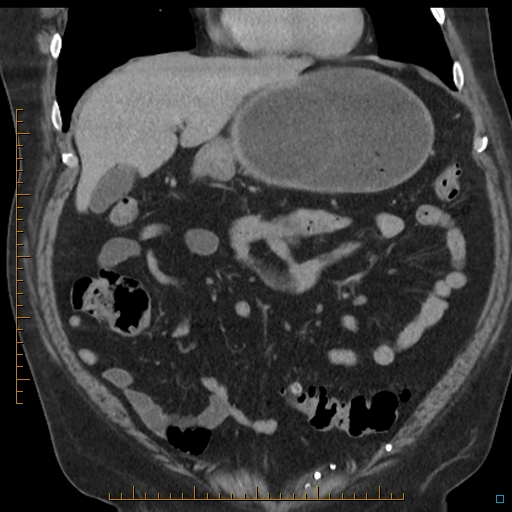 File:Bariatric balloon causing gastric outlet obstruction (Radiopaedia 54449-60672 B 19).jpg