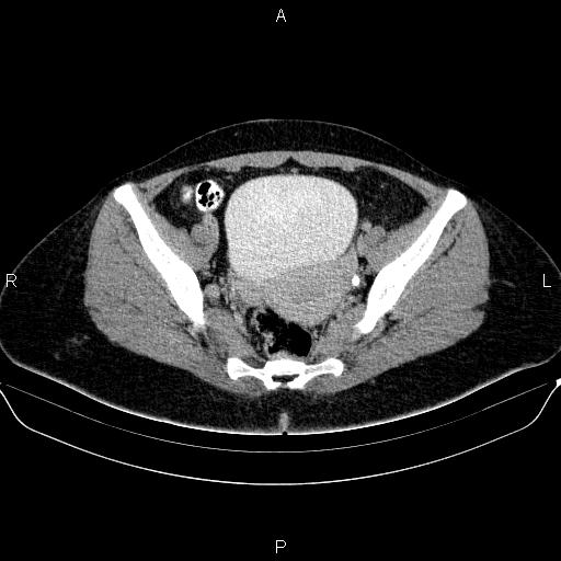 Bartholin gland cyst (Radiopaedia 62635-70930 C 41).jpg