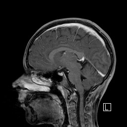 Base of skull rhabdomyosarcoma (Radiopaedia 32196-33142 J 31).jpg
