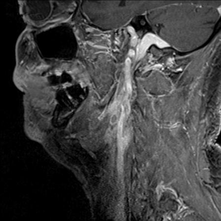 Base of tongue squamous cell carcinoma (Radiopaedia 31174-31884 F 126).jpg