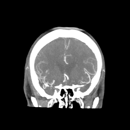 Basilar and bilateral vertebral artery occlusion (Radiopaedia 45592-49723 B 37).png