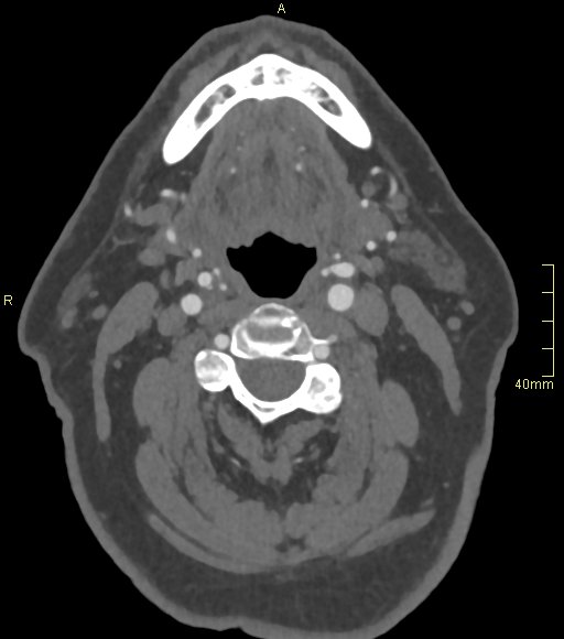 File:Basilar artery aneurysm (Radiopaedia 56261-62932 A 5).jpg